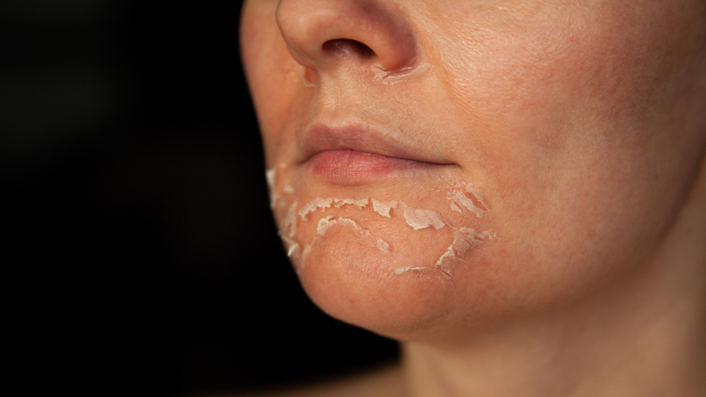 What is Chemical Exfoliation?