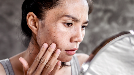 Hyperpigmentation After Age 30: Why Dark Spots Are Harder to Fade