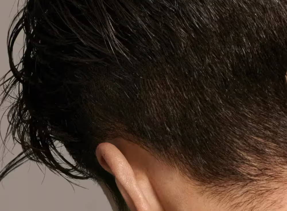 PRP Hair restoration