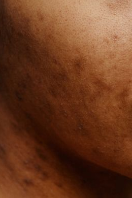 Anti-Pigmentation Facial