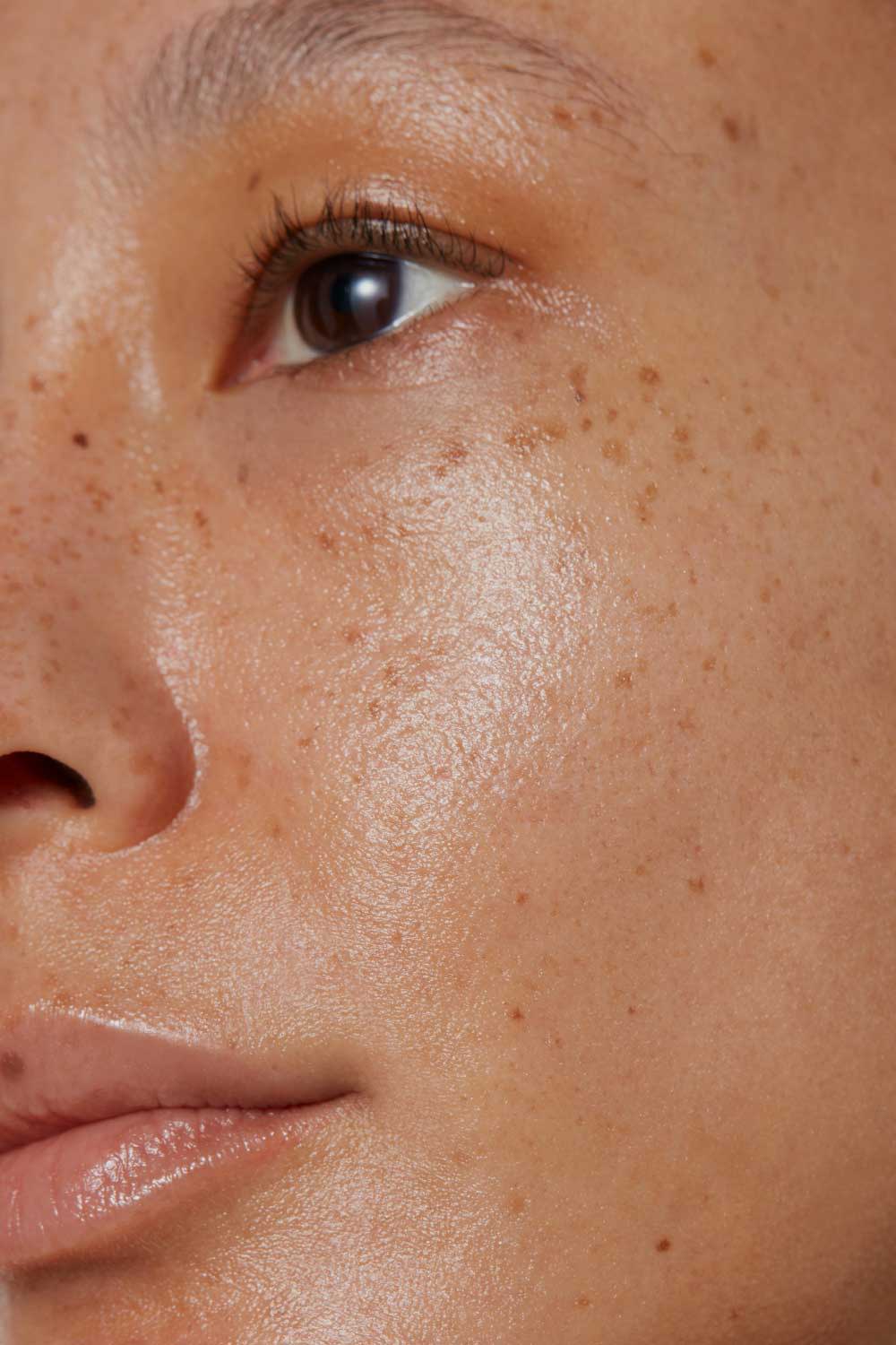 botox